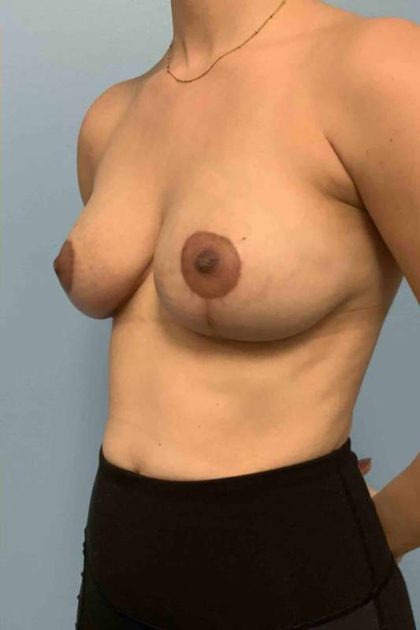 Breast Lift Before & After Patient #12042