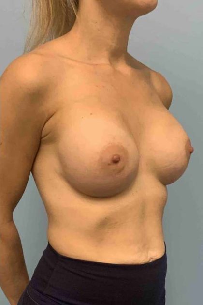 Breast Augmentation Before & After Patient #12056