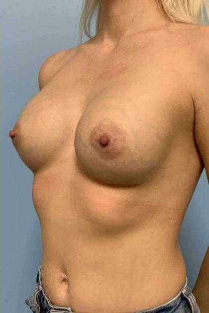 Breast Augmentation Before & After Patient #12063