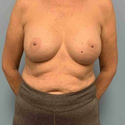 Breast Augmentation Before & After Patient #12082