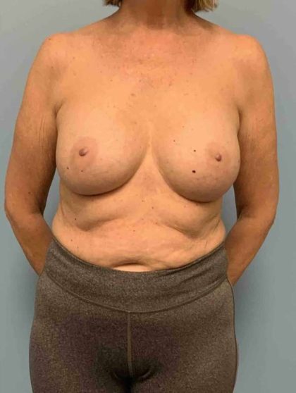 Breast Augmentation Before & After Patient #12082