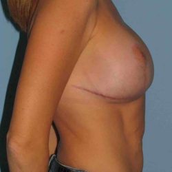 Breast Augmentation Before & After Patient #12094