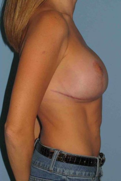 Breast Augmentation Before & After Patient #12094