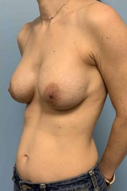 Breast Augmentation Before & After Patient #12108