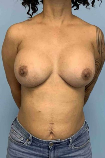 Breast Augmentation Before & After Patient #12113