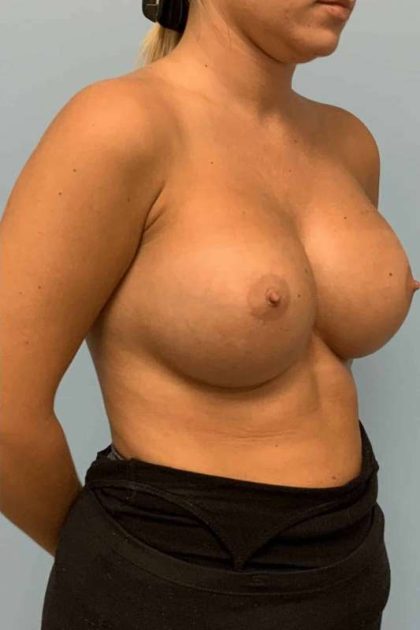 Breast Augmentation Before & After Patient #12120