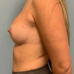 Breast Augmentation Before & After Patient #12127