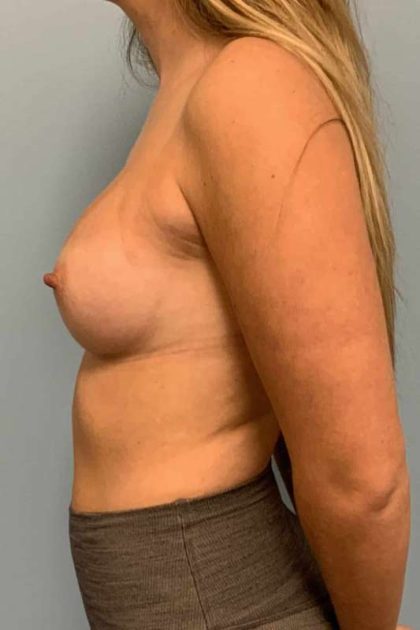 Breast Augmentation Before & After Patient #12127