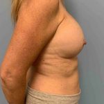 Breast Augmentation Before & After Patient #12150