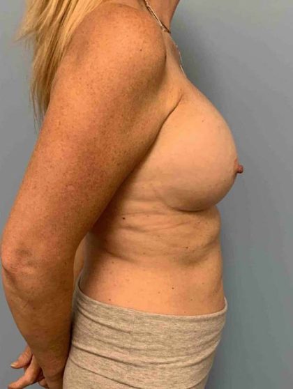 Breast Augmentation Before & After Patient #12150