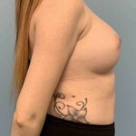Breast Augmentation Before & After Patient #12157