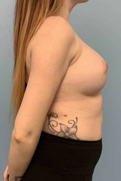 Breast Augmentation Before & After Patient #12157