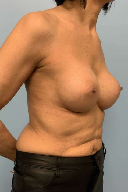 Breast Augmentation Before & After Patient #12171