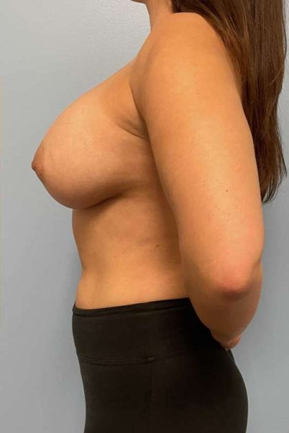 Breast Augmentation Before & After Patient #12178