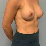 Breast Augmentation Before & After Patient #12206