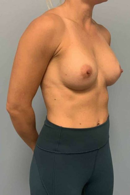 Breast Augmentation Before & After Patient #12206