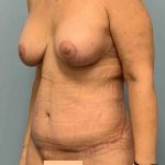 Breast Augmentation Before & After Patient #12213