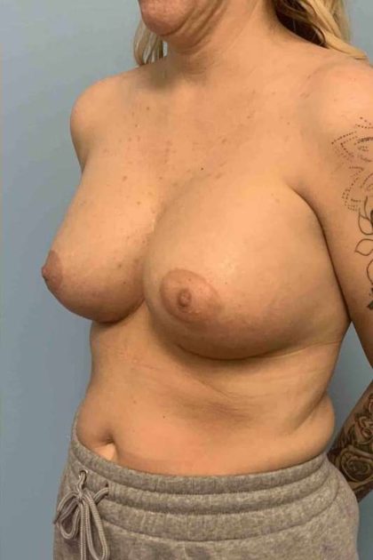 Breast Augmentation Before & After Patient #12227