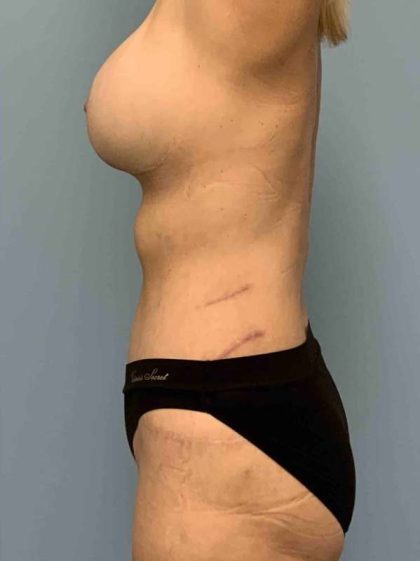 Breast Augmentation Before & After Patient #12239