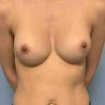 Breast Augmentation Before & After Patient #12267