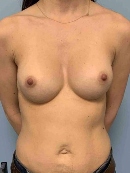 Breast Augmentation Before & After Patient #12267