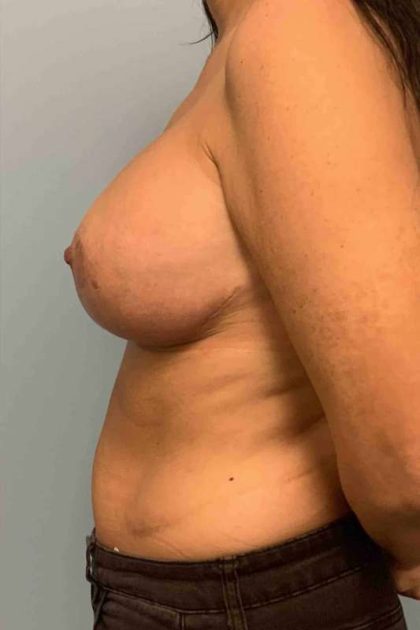 Breast Augmentation Before & After Patient #12274
