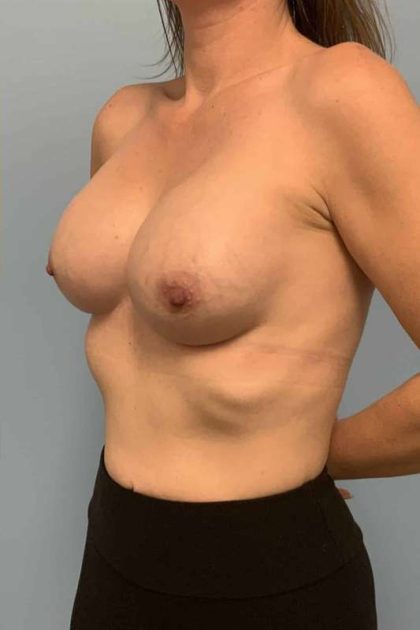 Breast Augmentation Before & After Patient #12295