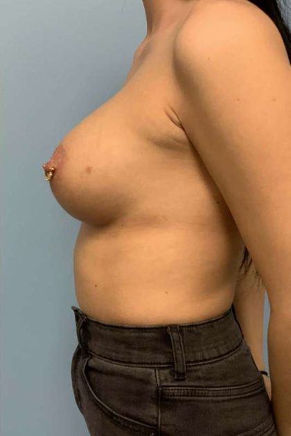 Breast Augmentation Before & After Patient #12323
