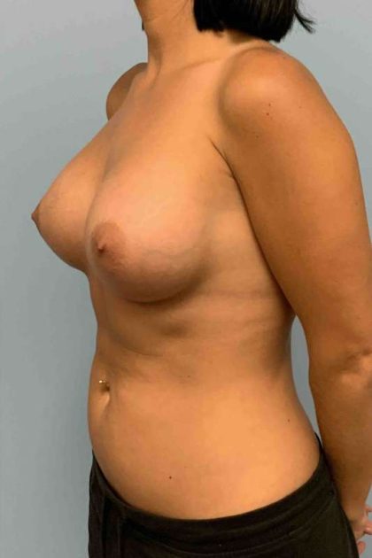Breast Augmentation Before & After Patient #12330