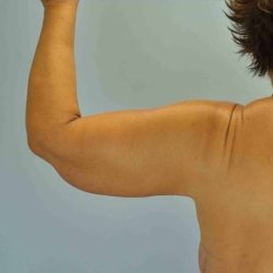 Brachioplasty Before & After Patient #12335