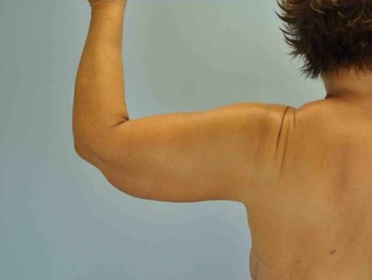 Brachioplasty Before & After Patient #12335