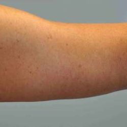 Brachioplasty Before & After Patient #12353