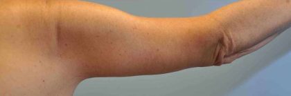 Brachioplasty Before & After Patient #12353