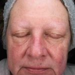 BBL Forever Young Before & After Patient #12386