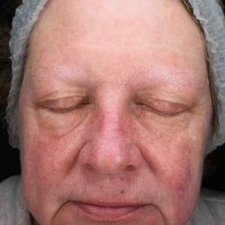 BBL Forever Young Before & After Patient #12386