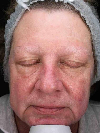 BBL Forever Young Before & After Patient #12386
