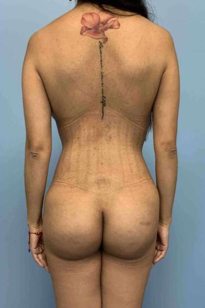 VASER Liposelection Before & After Patient #10416
