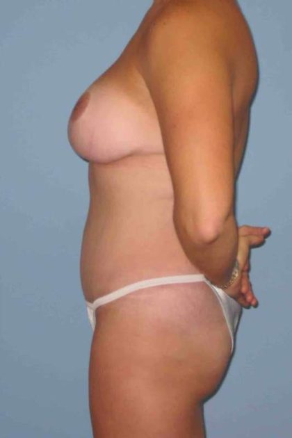 VASER Liposelection Before & After Patient #10425