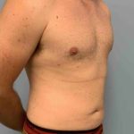 VASER Liposelection Before & After Patient #10434