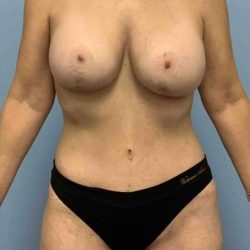 VASER Liposelection Before & After Patient #10439