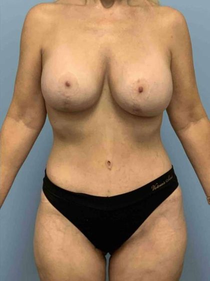 VASER Liposelection Before & After Patient #10439