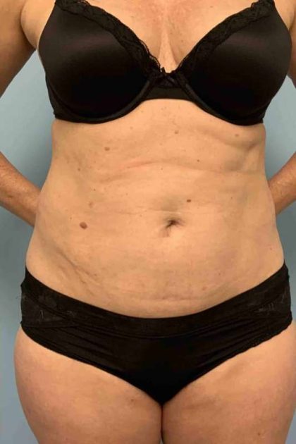 VASER Liposelection Before & After Patient #10446