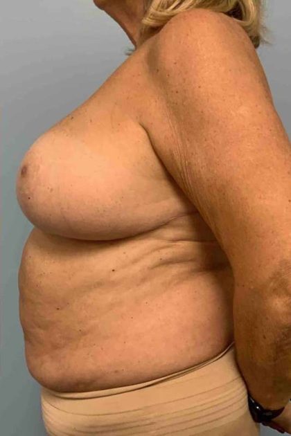 VASER Liposelection Before & After Patient #10466