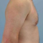VASER Liposelection Before & After Patient #10486
