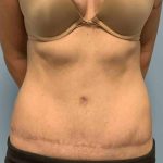 VASER Liposelection Before & After Patient #10493