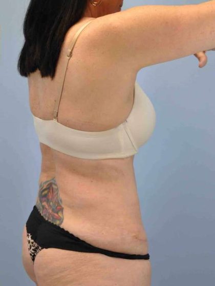VASER Liposelection Before & After Patient #10511