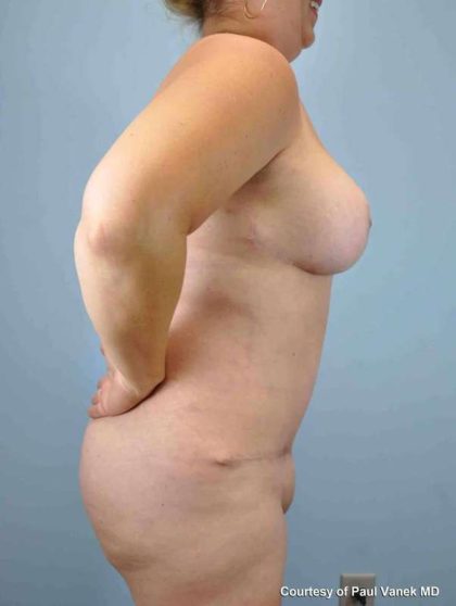VASER Liposelection Before & After Patient #10520