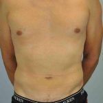 VASER Liposelection Before & After Patient #10527