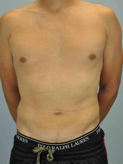 VASER Liposelection Before & After Patient #10527