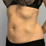 VASER Liposelection Before & After Patient #10407